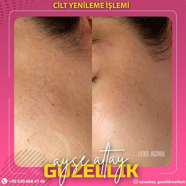 Ayşe Altay Güzellik Merkezi - 69. Fotoğraf