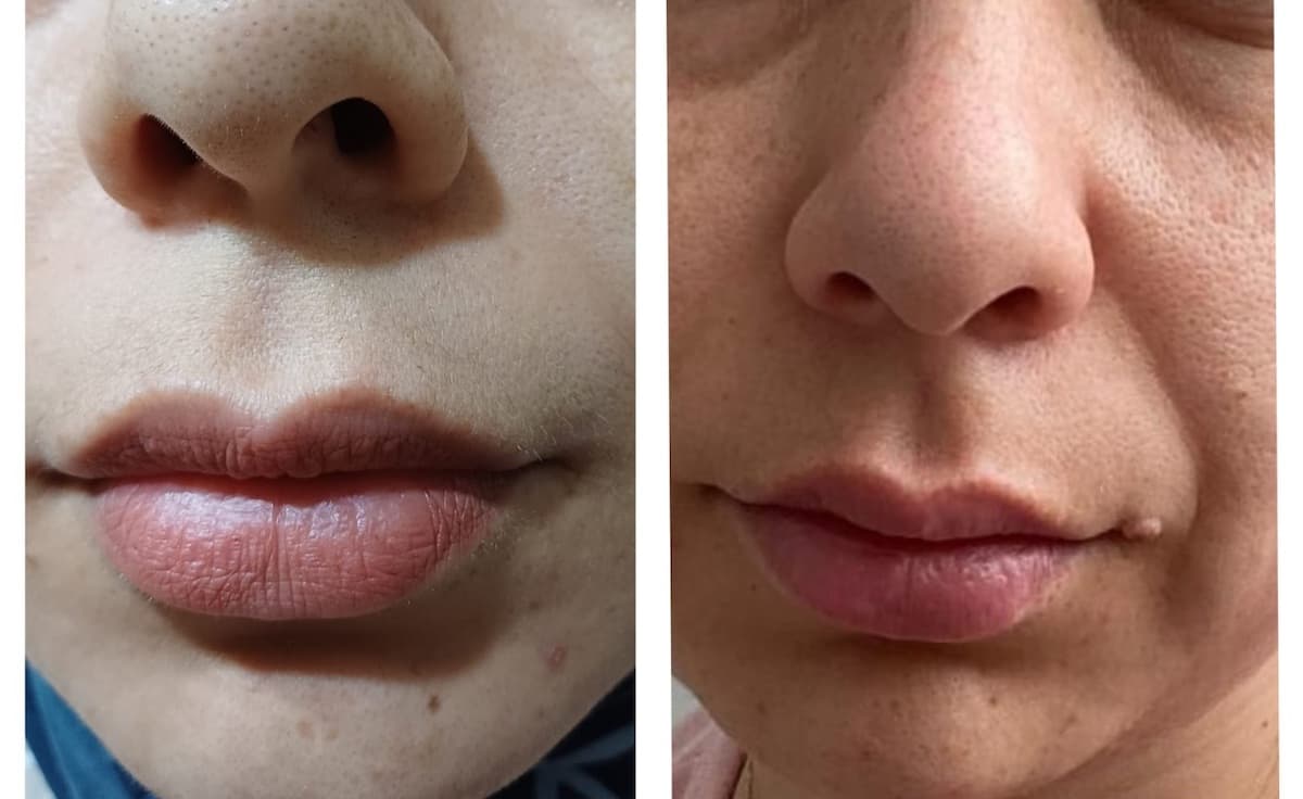 Touch Güzellik Salonu - Batıkent Cilt Renk Tonu Açma - 3. Fotoğraf