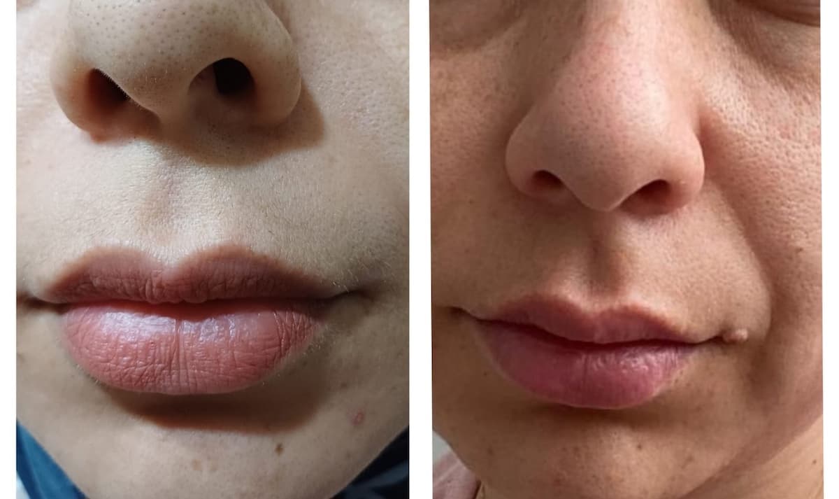 Touch Güzellik Salonu - Batıkent Cilt Yenileme - 4. Fotoğraf