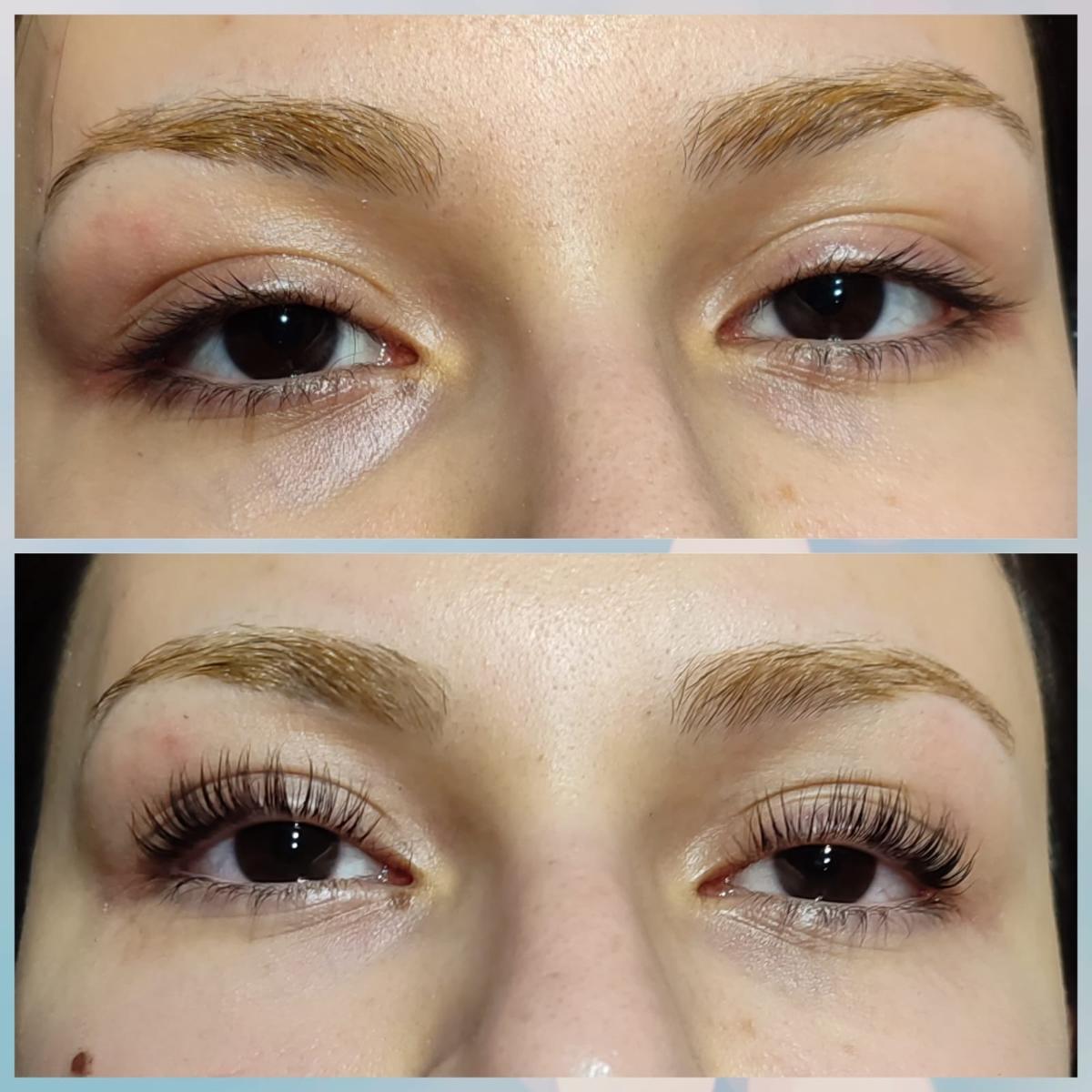 Merve Şensoy Güzellik Merkezi - Altındağ Ameliyatsız Yüz Germe - 2. Fotoğraf