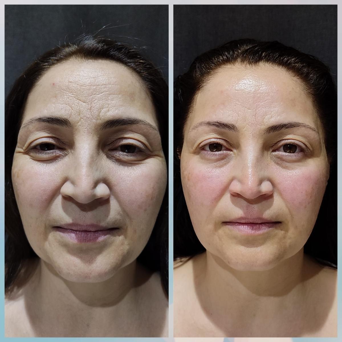 Merve Şensoy Güzellik Merkezi - Altındağ Ameliyatsız Yüz Germe - 3. Fotoğraf