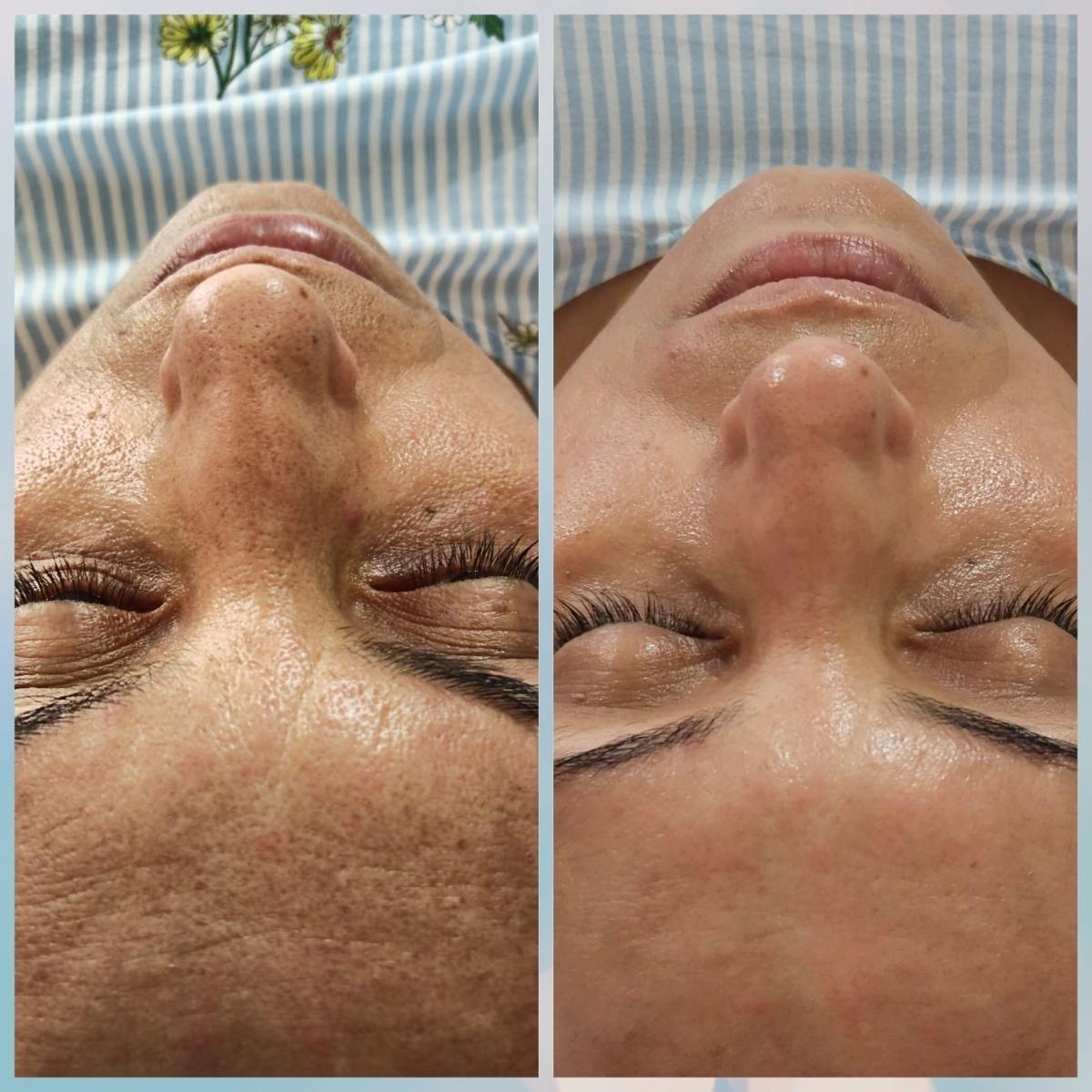 Merve Şensoy Güzellik Merkezi - Altındağ Ameliyatsız Yüz Germe - 4. Fotoğraf