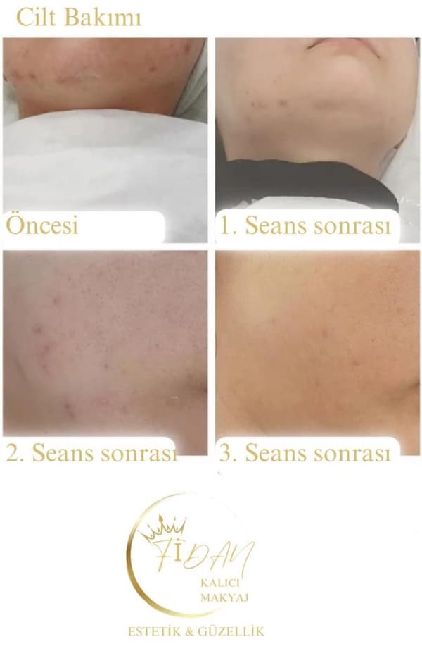 Fidan Kalıcı Makyaj Estetik Güzellik - 12. Fotoğraf Fidan Kalıcı Makyaj Estetik Güzellik - 12. Fotoğraf