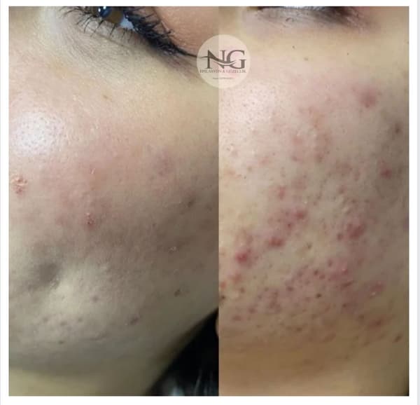 Nergis Epilasyon ve Güzellik - 8. Fotoğraf Nergis Epilasyon ve Güzellik - 8. Fotoğraf